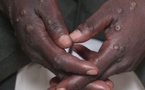Cinq cas de Mpox confirmés au Mali, dont un décès