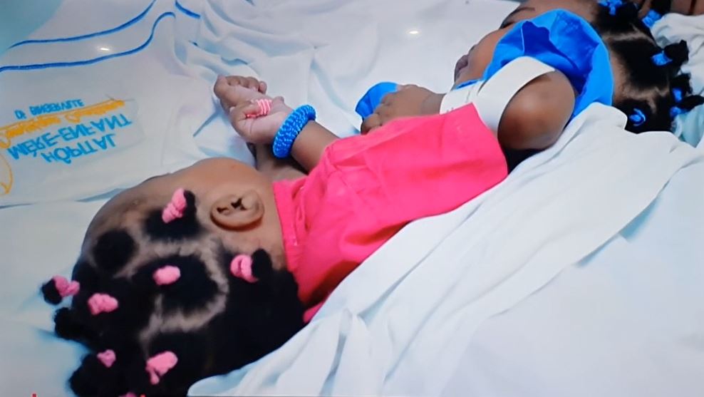 Bébés siamois, sœurs siamoises séparées en Côte d'Ivoire Bébés siamois, sœurs siamoises séparées en Côte d'Ivoire